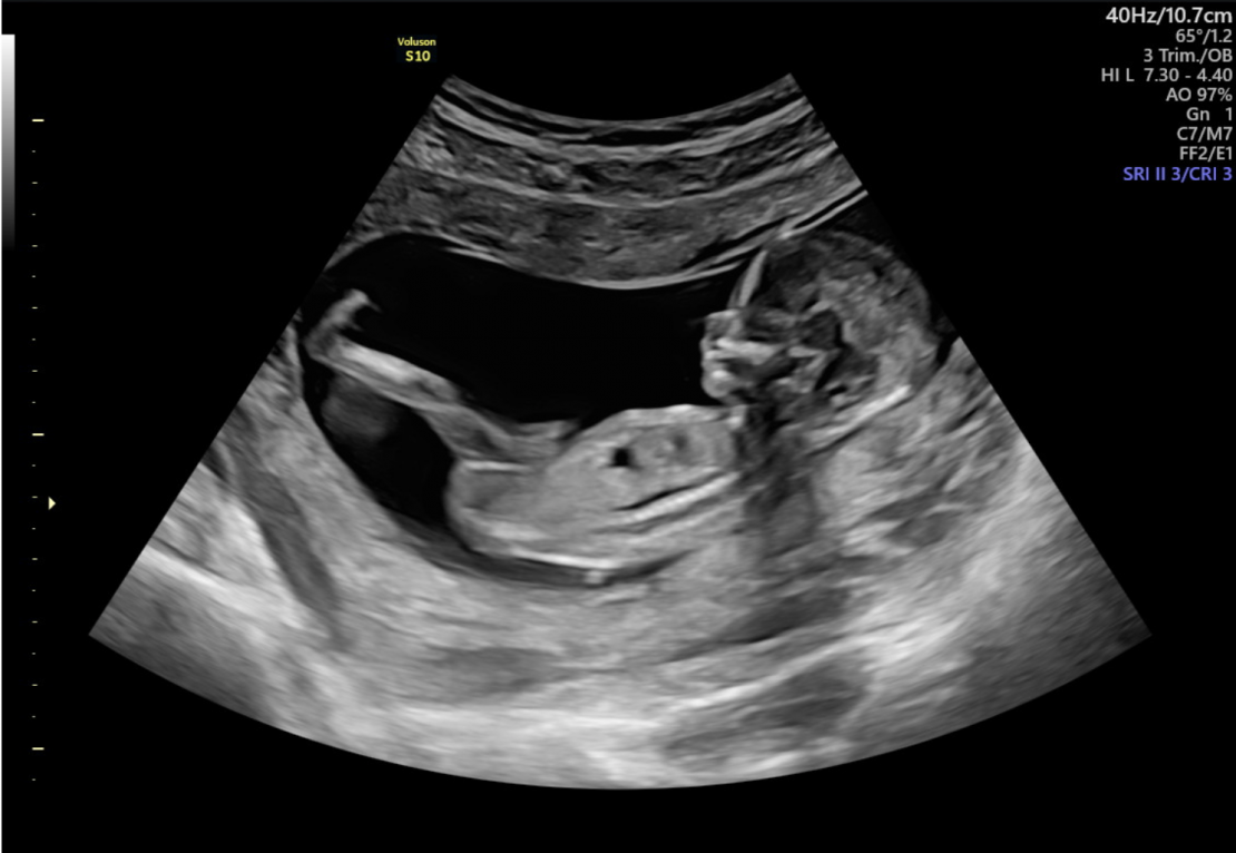 13-week-ultrasound-femme